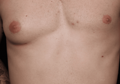 Gynecomastia Before & After Patient #30854