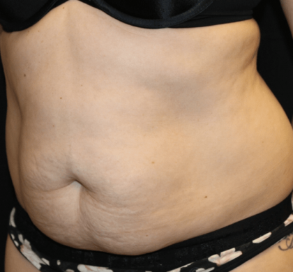 Tummy Tuck Before & After Patient #30841