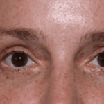 Blepharoplasty Before & After Patient #30729