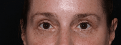 Blepharoplasty Before & After Patient #30729