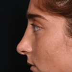 Rhinoplasty Before & After Patient #30832