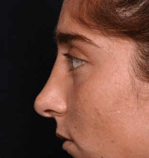 Rhinoplasty Before & After Patient #30832