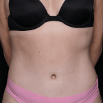 Tummy Tuck Before & After Patient #30841