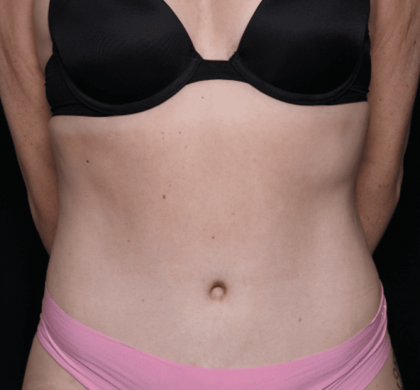 Tummy Tuck Before & After Patient #30841