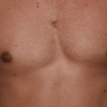 Gynecomastia Before & After Patient #30854