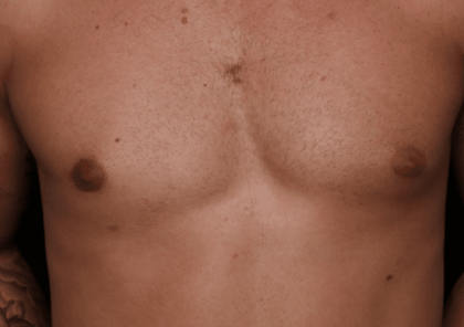 Gynecomastia Before & After Patient #30854