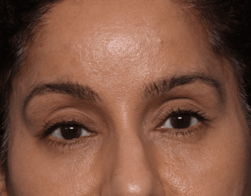 Blepharoplasty and Brow Lift Before & After Patient #30696