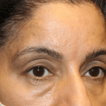 Blepharoplasty and Brow Lift Before & After Patient #30696