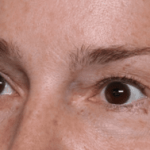 Blepharoplasty Before & After Patient #30729