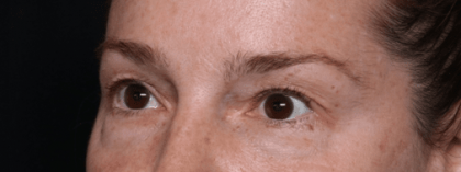 Blepharoplasty Before & After Patient #30729