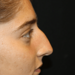 Rhinoplasty Before & After Patient #30832