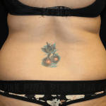 Tummy Tuck Before & After Patient #30841