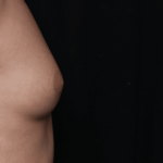 Gynecomastia Before & After Patient #30854