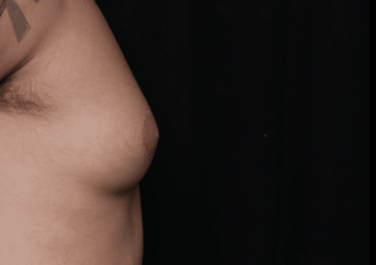 Gynecomastia Before & After Patient #30854