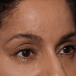 Blepharoplasty and Brow Lift Before & After Patient #30696