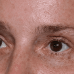 Blepharoplasty Before & After Patient #30729