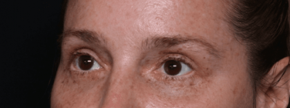 Blepharoplasty Before & After Patient #30729