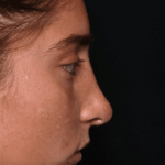 Rhinoplasty Before & After Patient #30832