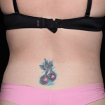 Tummy Tuck Before & After Patient #30841