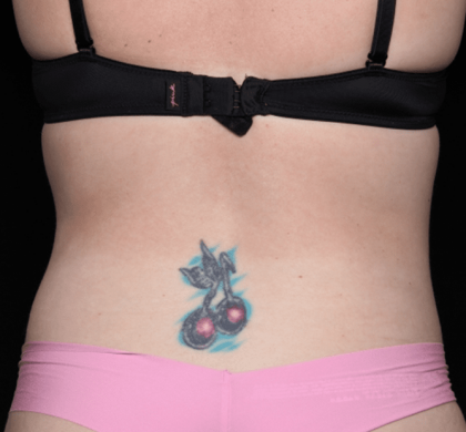 Tummy Tuck Before & After Patient #30841