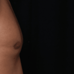 Gynecomastia Before & After Patient #30854