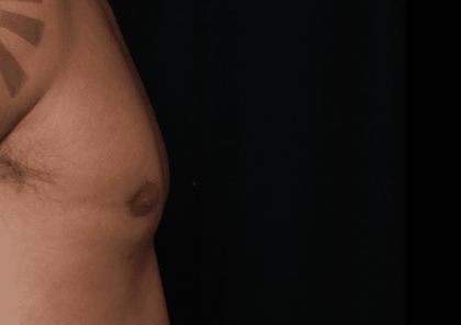 Gynecomastia Before & After Patient #30854