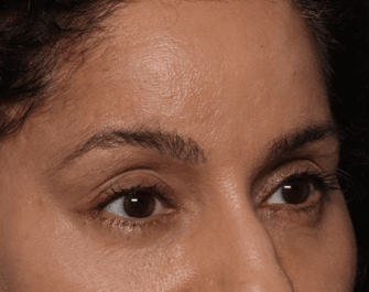 Blepharoplasty and Brow Lift Before & After Patient #30696