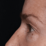 Blepharoplasty Before & After Patient #30729