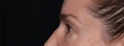 Blepharoplasty Before & After Patient #30729