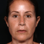 Injectable Fillers Before & After Patient #30824