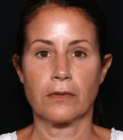 Injectable Fillers Before & After Patient #30824