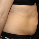 Tummy Tuck Before & After Patient #30841