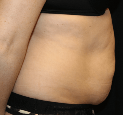 Tummy Tuck Before & After Patient #30841