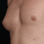 Gynecomastia Before & After Patient #30854