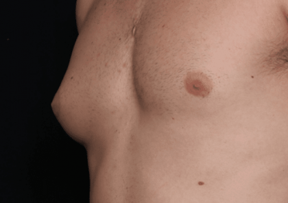 Gynecomastia Before & After Patient #30854