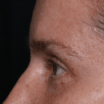 Blepharoplasty Before & After Patient #30729