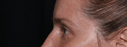 Blepharoplasty Before & After Patient #30729