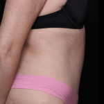 Tummy Tuck Before & After Patient #30841