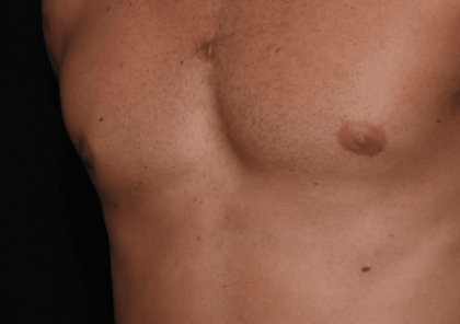 Gynecomastia Before & After Patient #30854
