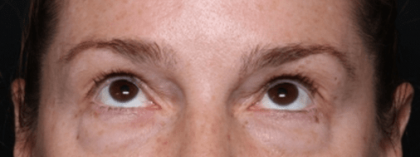 Blepharoplasty Before & After Patient #30729