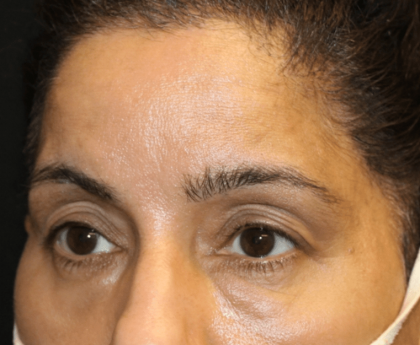 Blepharoplasty and Brow Lift Before & After Patient #30696