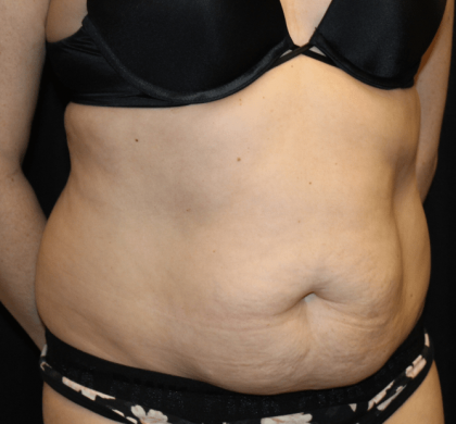 Tummy Tuck Before & After Patient #30841