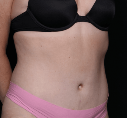 Tummy Tuck Before & After Patient #30841