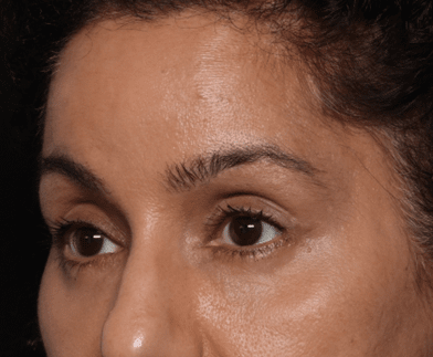 Blepharoplasty and Brow Lift Before & After Patient #30696