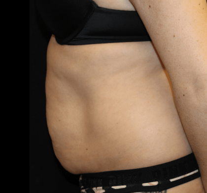 Tummy Tuck Before & After Patient #30841