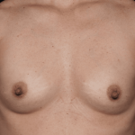 Breast Before & After Patient #30775