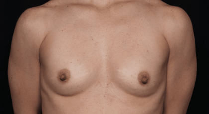 Breast Before & After Patient #30775