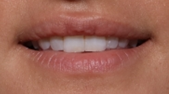 Lip Filler Before & After Patient #30788
