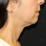 Neck Lift Before & After Patient #30795
