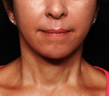 Neck Lift Before & After Patient #30795